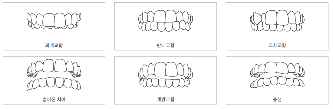 부정교합 분류